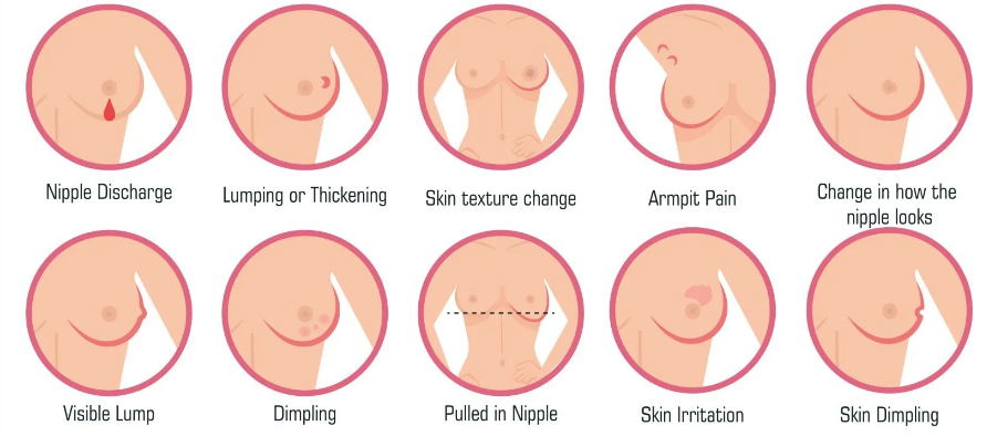 A visual on breast changes to look out for.